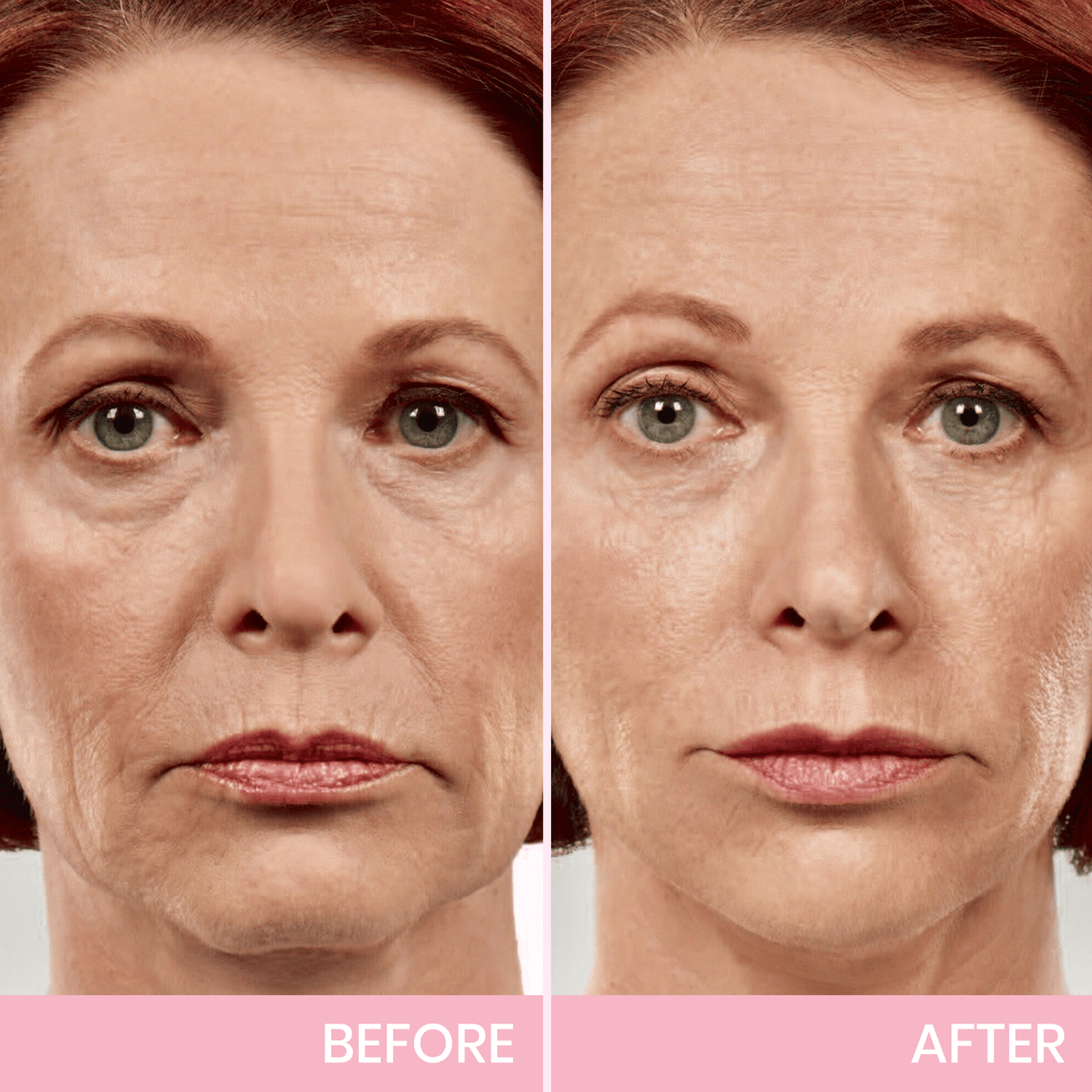 Instant V-Shape Face Tape