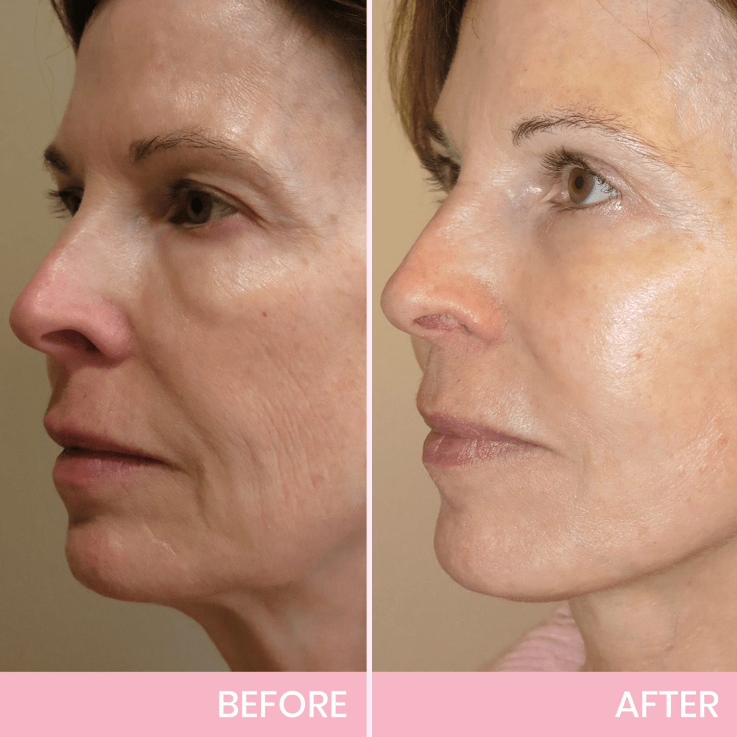 Instant V-Shape Face Tape